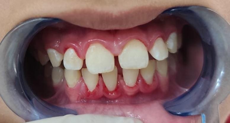 dientes post limpieza