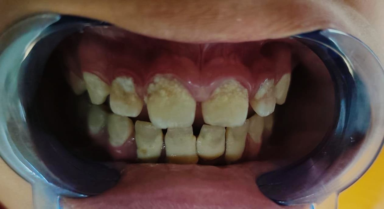 Limpieza dental, piezas dentales con sarro
